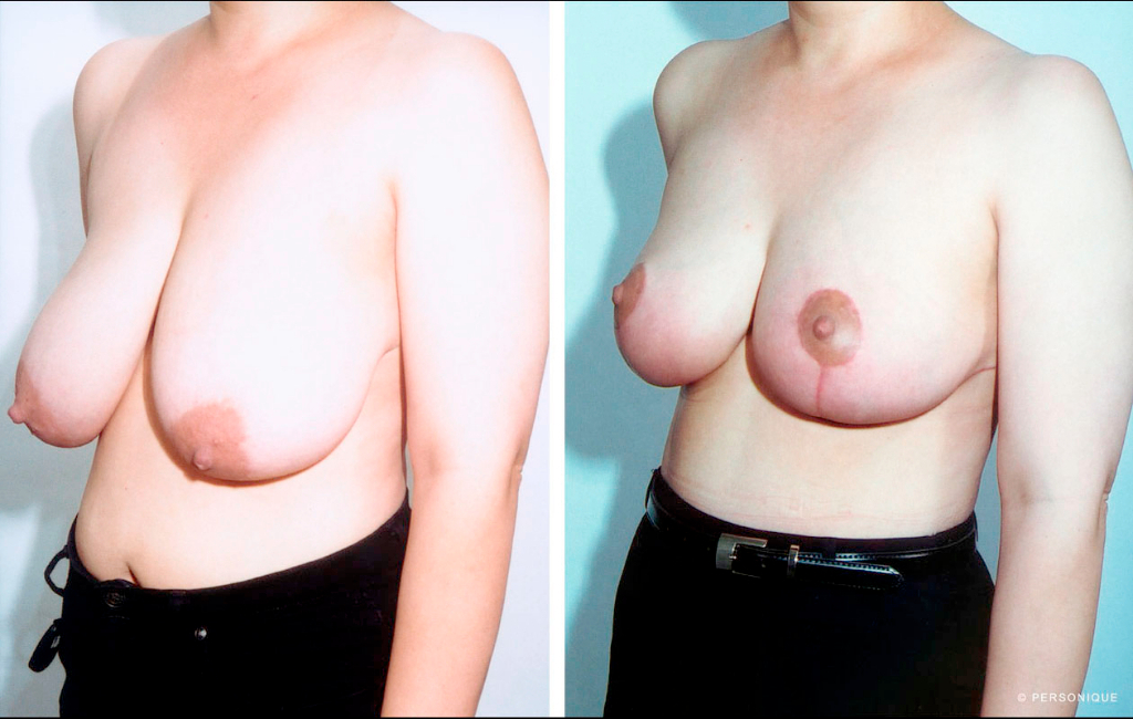 breast-reduction-austin-12.